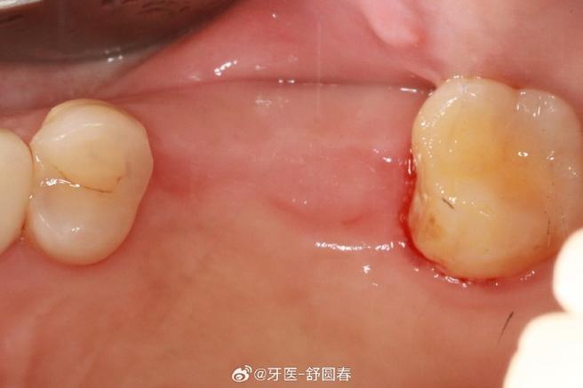 種植即刻修復 舒醫(yī)生的診療日常與醫(yī)學匠心